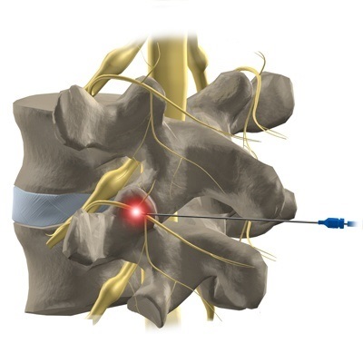 Medial-Branch-Block-Injection.jpg