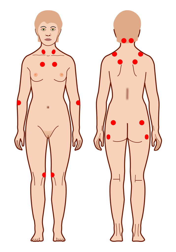 Tender points fibromyalgia.svg