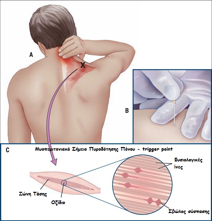 dry-needling