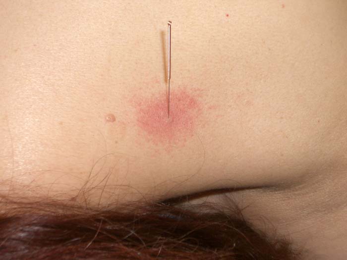 dryneedling 01