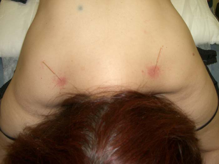 dryneedling 02