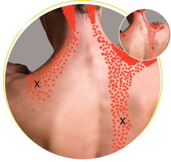 trigger point trapezious