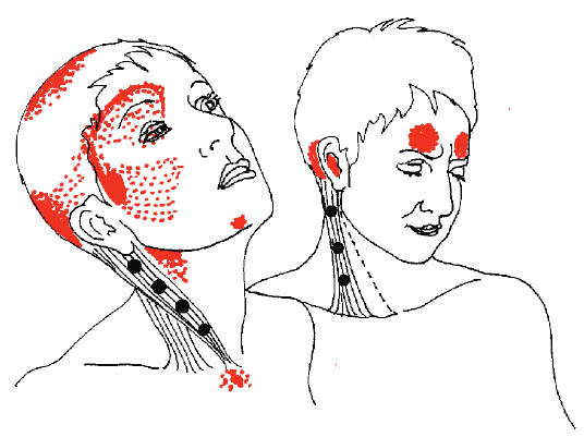 triggerpoints3
