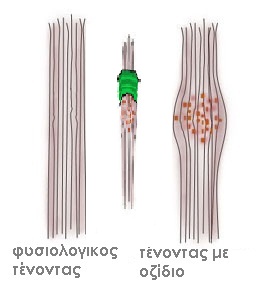 Trigger Finger illustration collagen small
