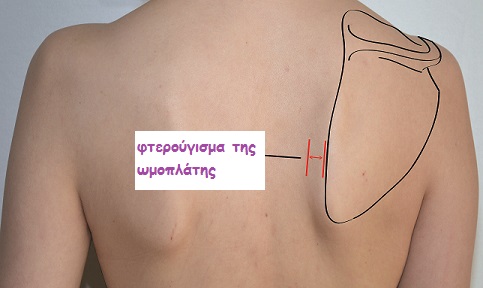 Winging-Scapula