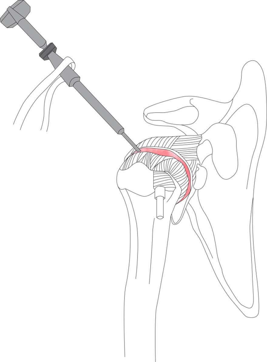arthroscopic release