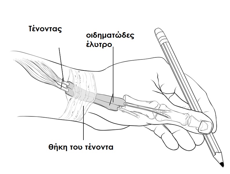 de quervains.1