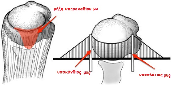 rotator-cuff-suspension-bridge1