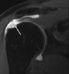 rotator-cuff-tear