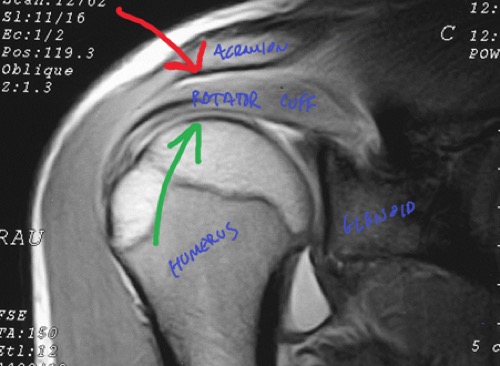 shoulder-impingement-assessment-and-treatment
