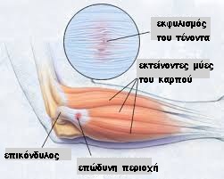 tenniselbow1