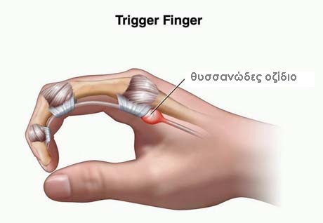trigger-finger