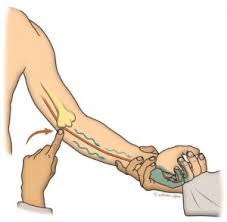 ulnar1