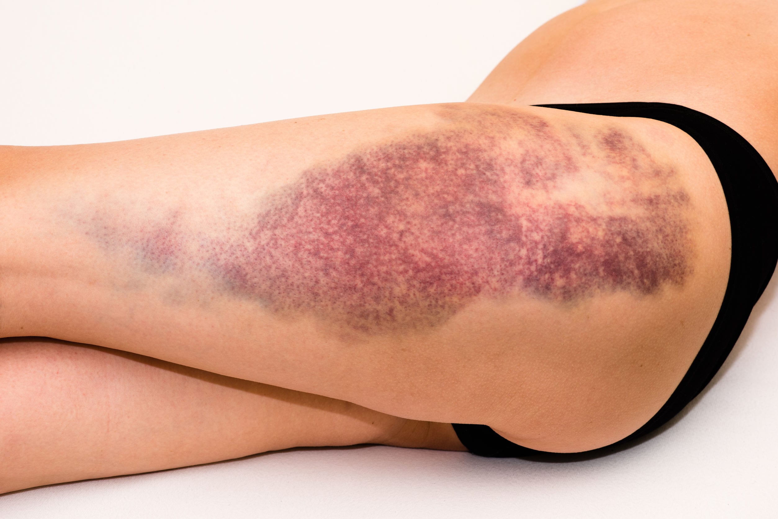 Soft-Tissue-Injuries