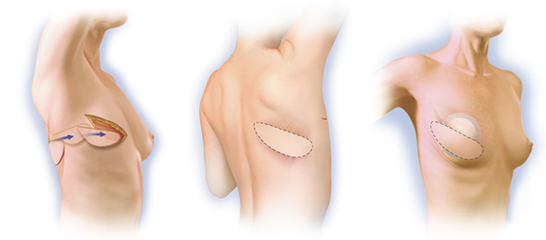 p27 latissimusDorsi 1-3