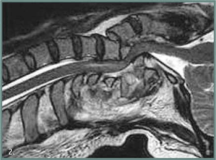 spinal3a