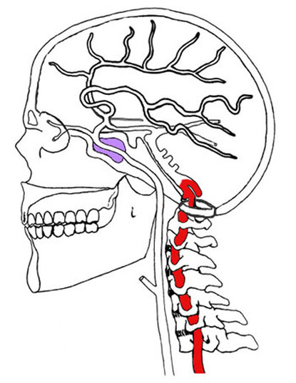 Vertebrobasilar