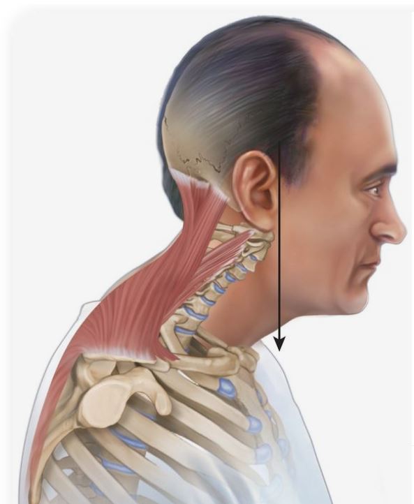upper cross syndrome1