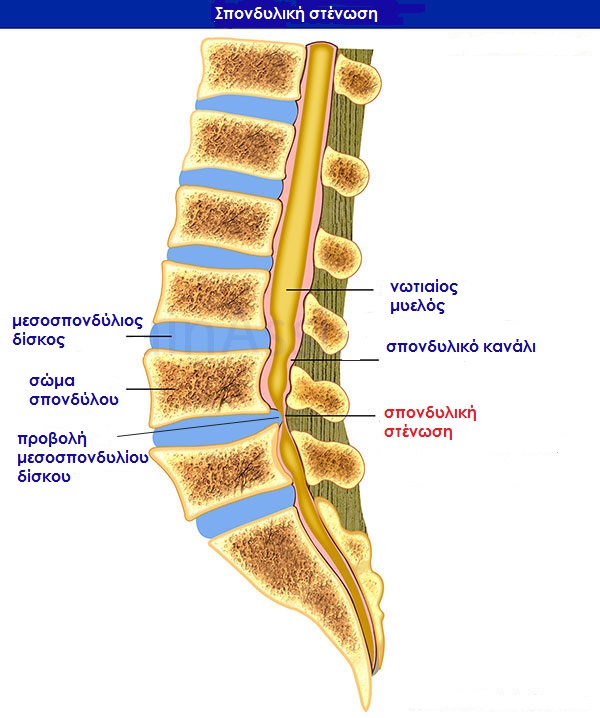 Spinal-Stenosis