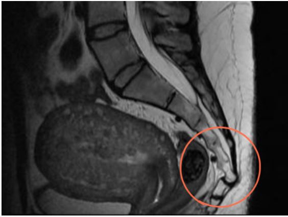 coccydynia1a