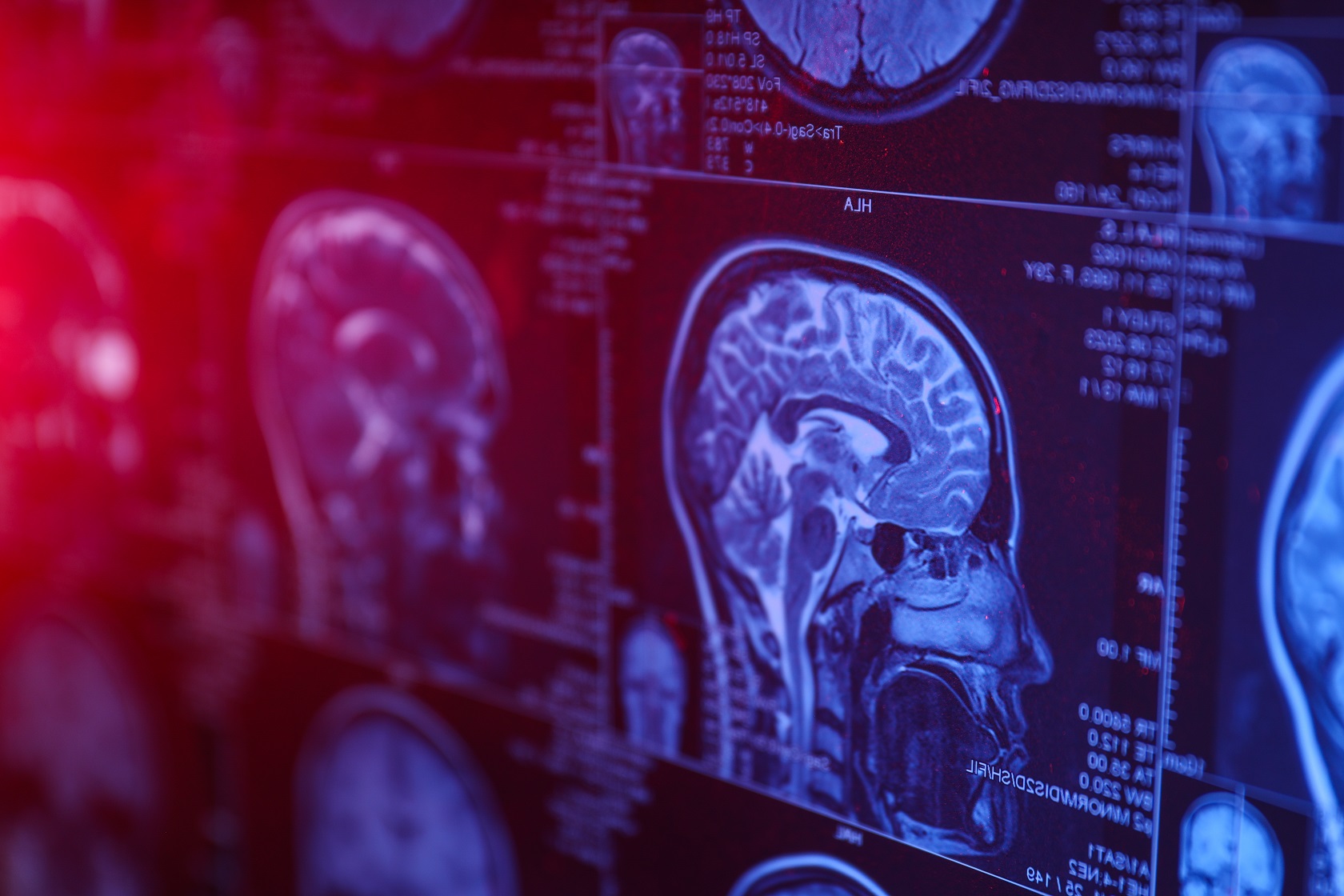 mri or magnetic resonance imaging of the head 