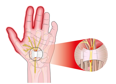 carpal-tunnel-syndrome