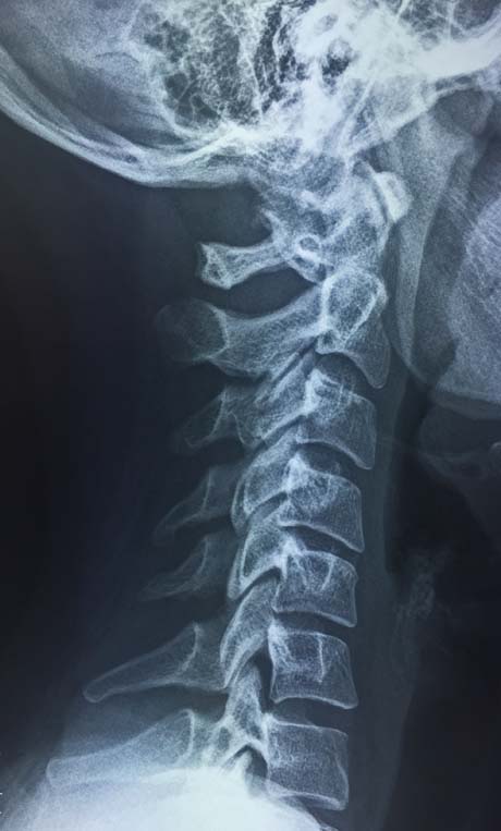 cervical