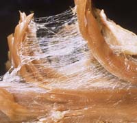 fascia gluteal