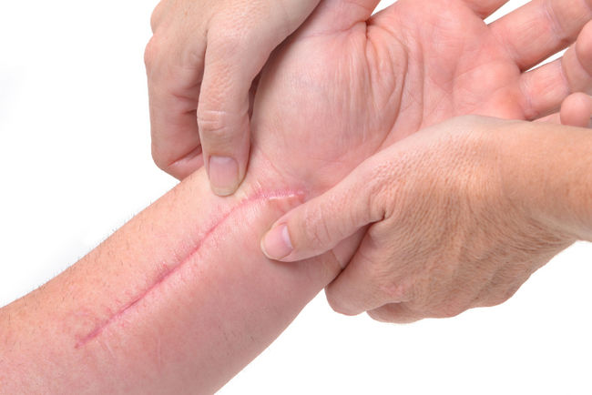 how-to-soften-scars-massage