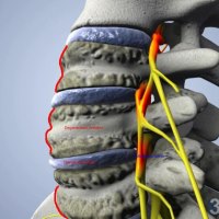 pinched-nerve-vs-not.-no.-1-facebook-page-Spanish