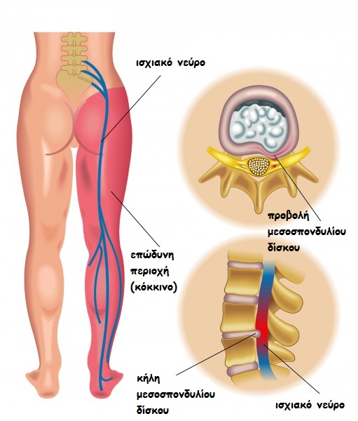 sciatic-pain1