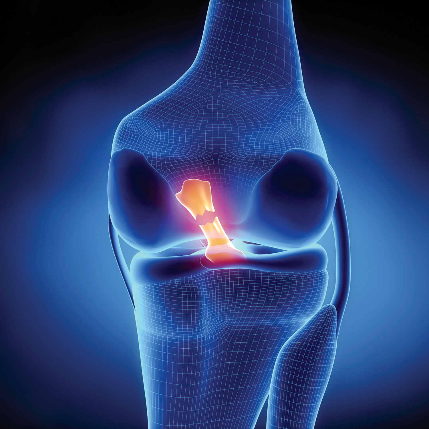 ACL-tear