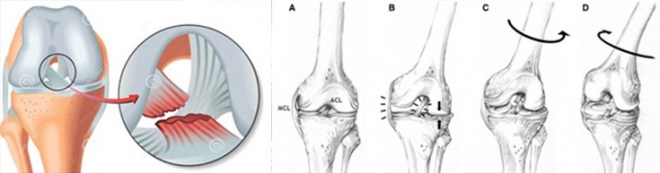 ACL-tear2
