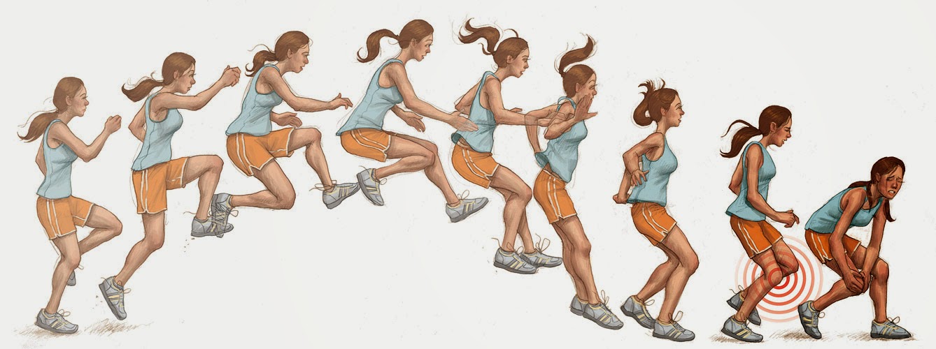 ACL-tear3