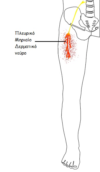 Meralgia  Paresthetica