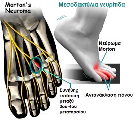 Mortons-interdigital-neuroma