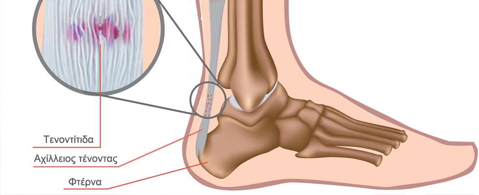 achilles tendon