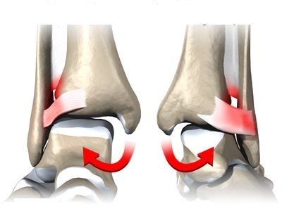 ankle syndesmosis causes01
