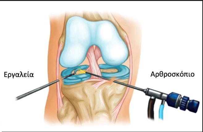 arthroscopisis