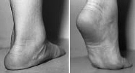 flatfoot2
