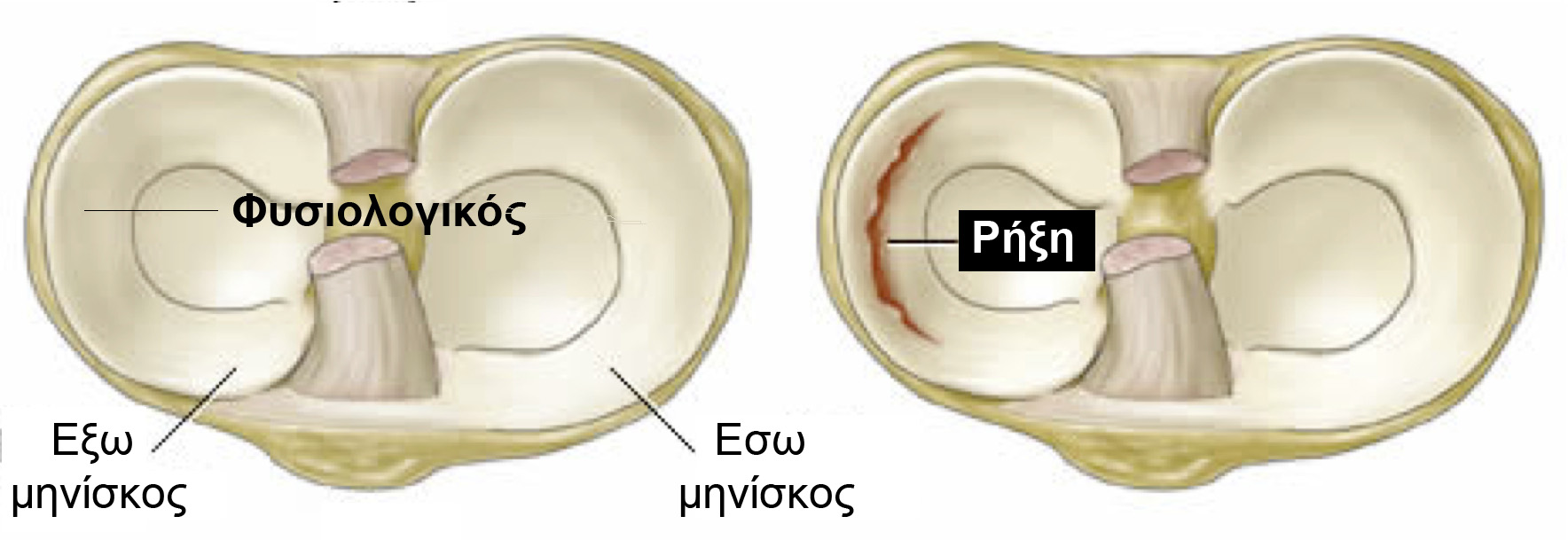 meniscus.tear