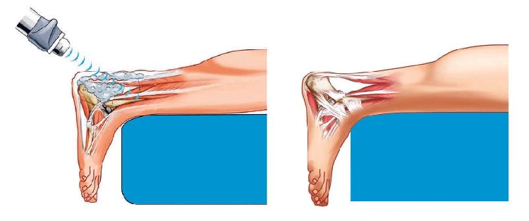 shockwave-therapy-01