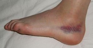 sprain1