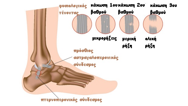 sprained-ankle