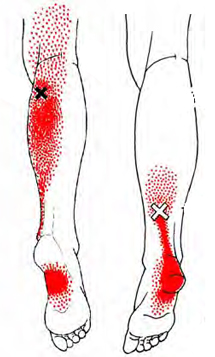 trigger point gastro