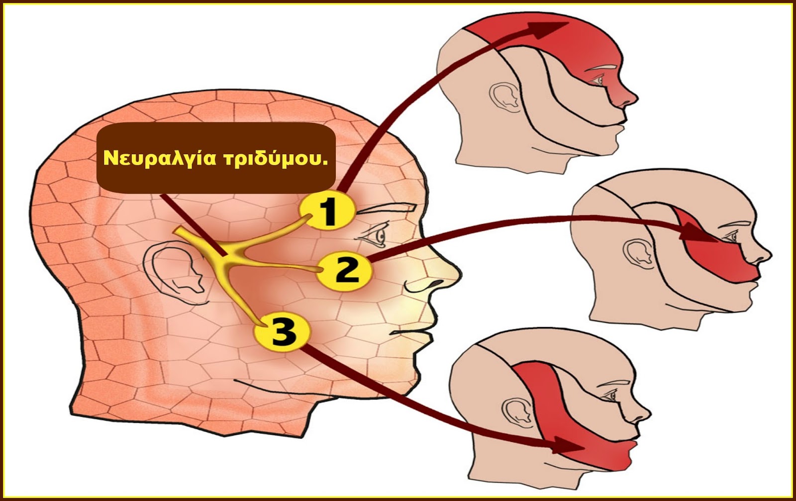 Trigeminal Neuralgia