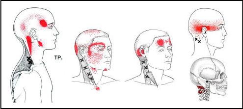 headache-trigger-point-diagram