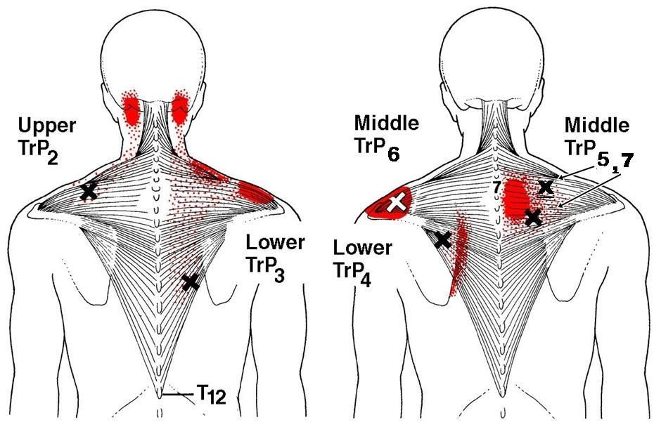 trapezius-2-3-trigger-points
