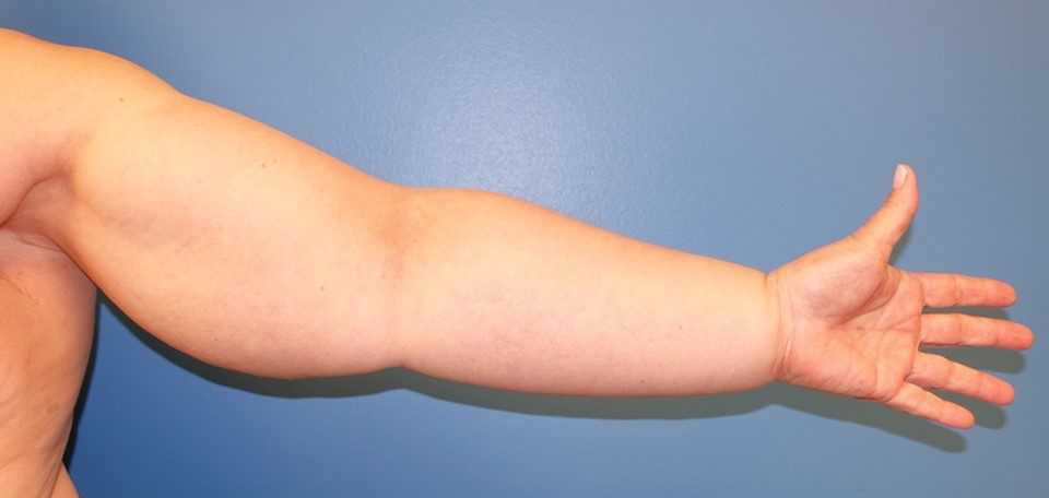 Lymphedema 1