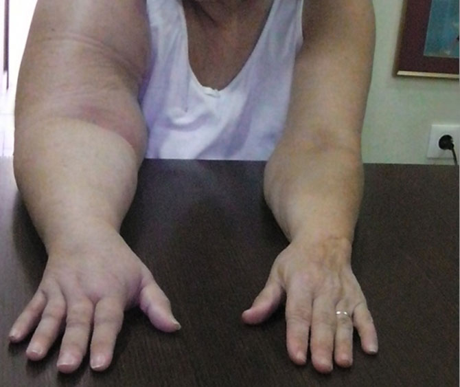 lemfidima deuterogenes therapia 09